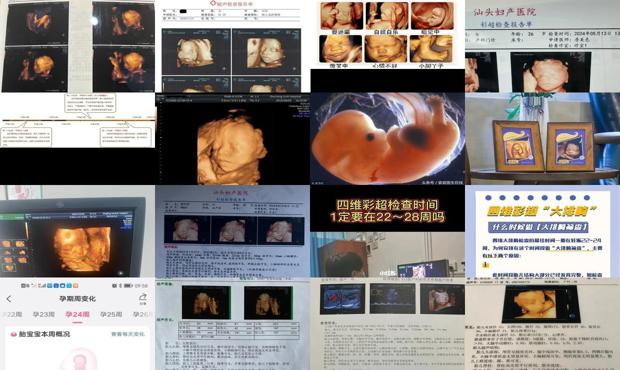 汕头四维彩超*佳时间