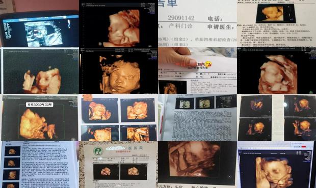 汕头22周做四维会不会太早