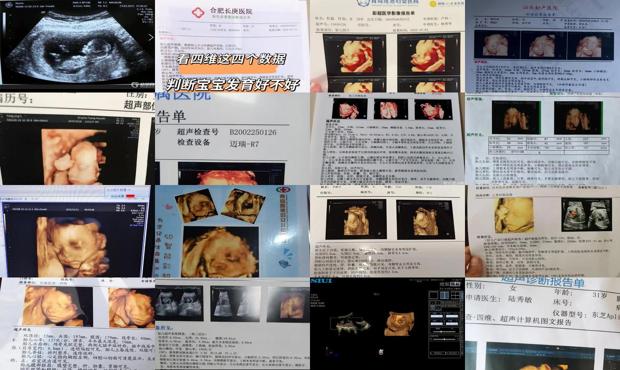 汕头如何看四维彩超