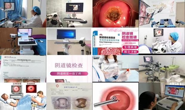 汕头阴道镜是检查什么的
