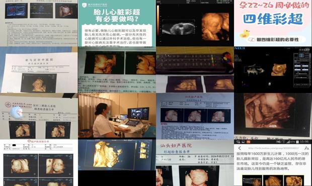 汕头没有做四维彩超怎么办