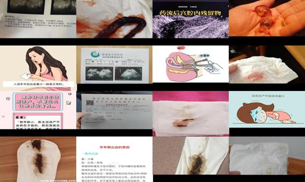汕头流产后没出血正常吗