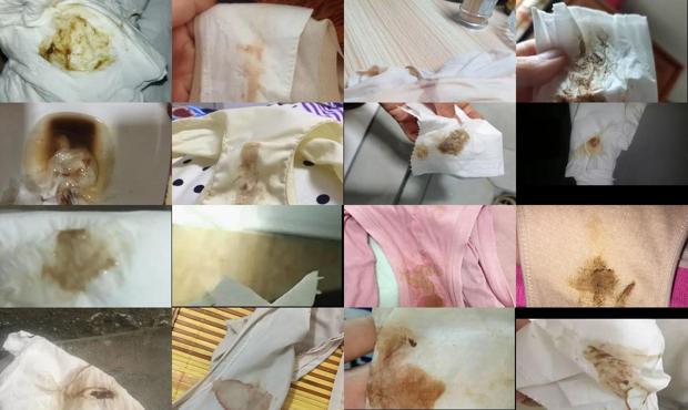 汕头下体流出褐色液体