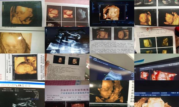 汕头五个月宝宝四维彩超