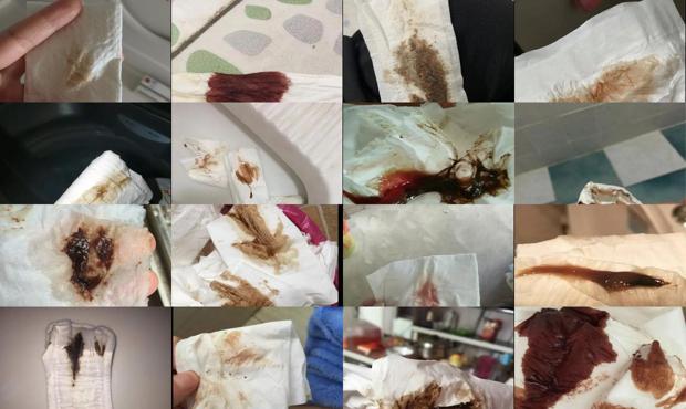 汕头怀孕流褐色血的误区