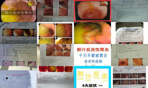 汕头胆汁反流性胃炎