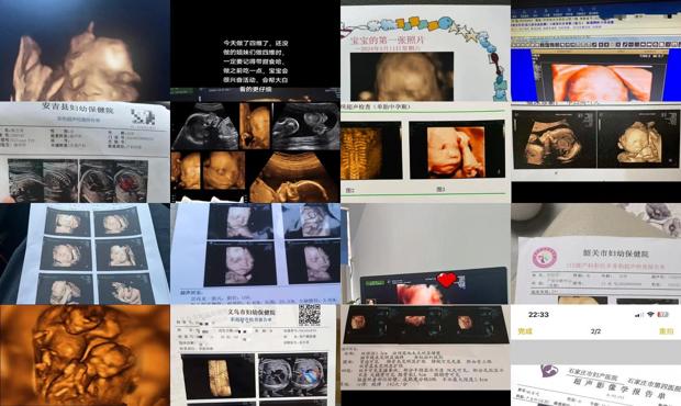 汕头四个月四维彩超