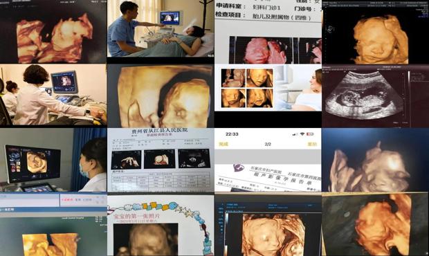 汕头孕妇要照四维彩超吗