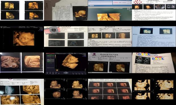 汕头大排畸是四维吗