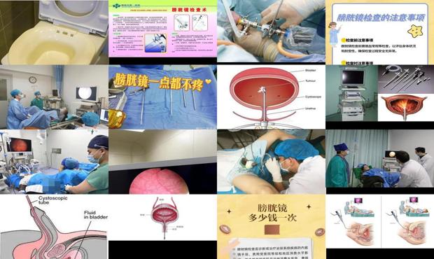 汕头膀胱镜检查多少钱