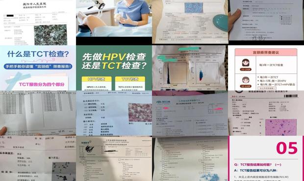 汕头tct检查是什么