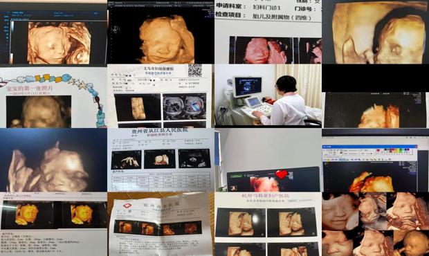 汕头孕妇六个月四维彩超