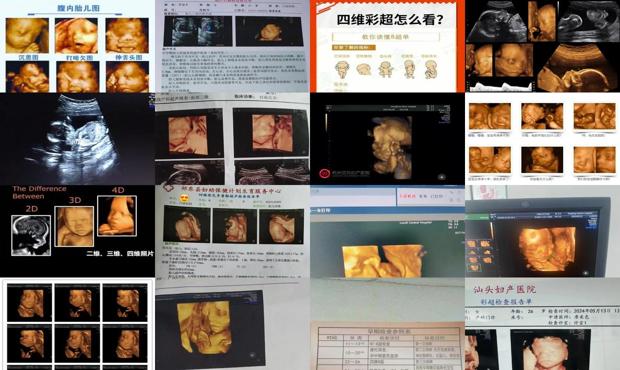 汕头四维几个月做*合适