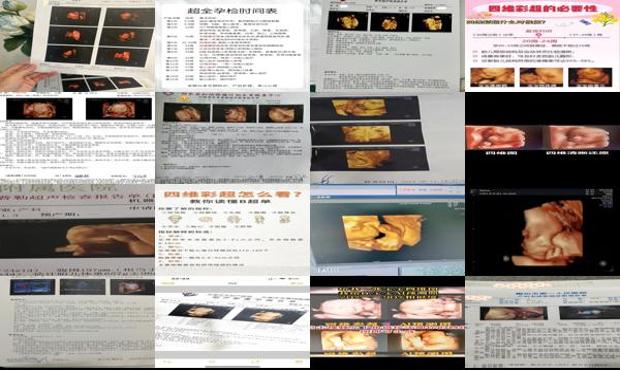 汕头四维彩超*佳时间是多少周