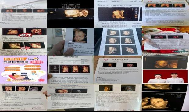 汕头四维彩超能查出哪些