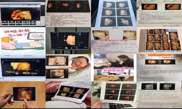 汕头四个月可以做四维彩超吗